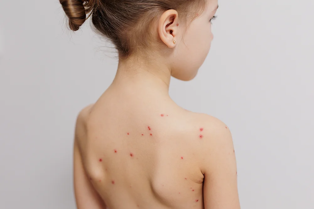 Chickenpox Vaccine